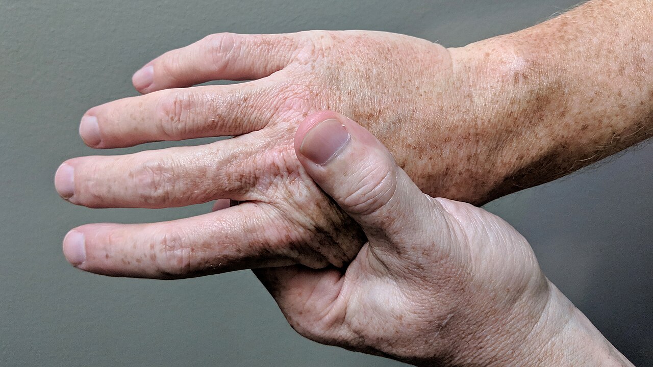 A person presses the thumb of one hand into the knuckles of the other hand to ease pain