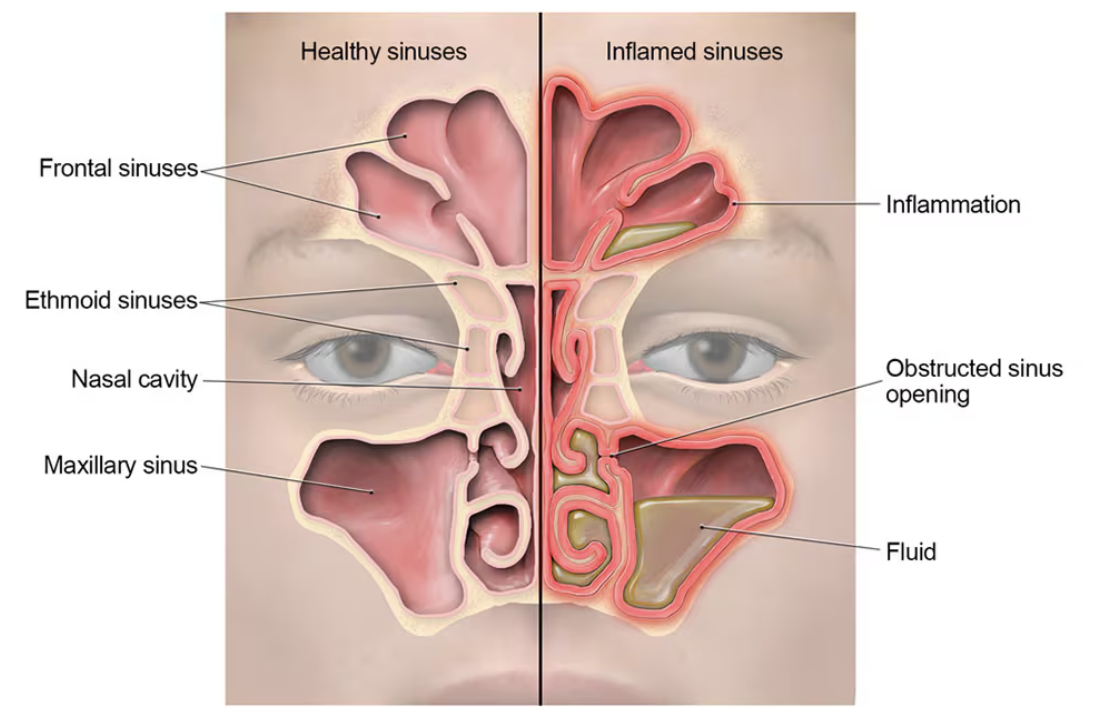 An illustration comparing healthy sinuses with inflamed sinuses, with the frontal, ethmoid and maxillary sinuses labelled