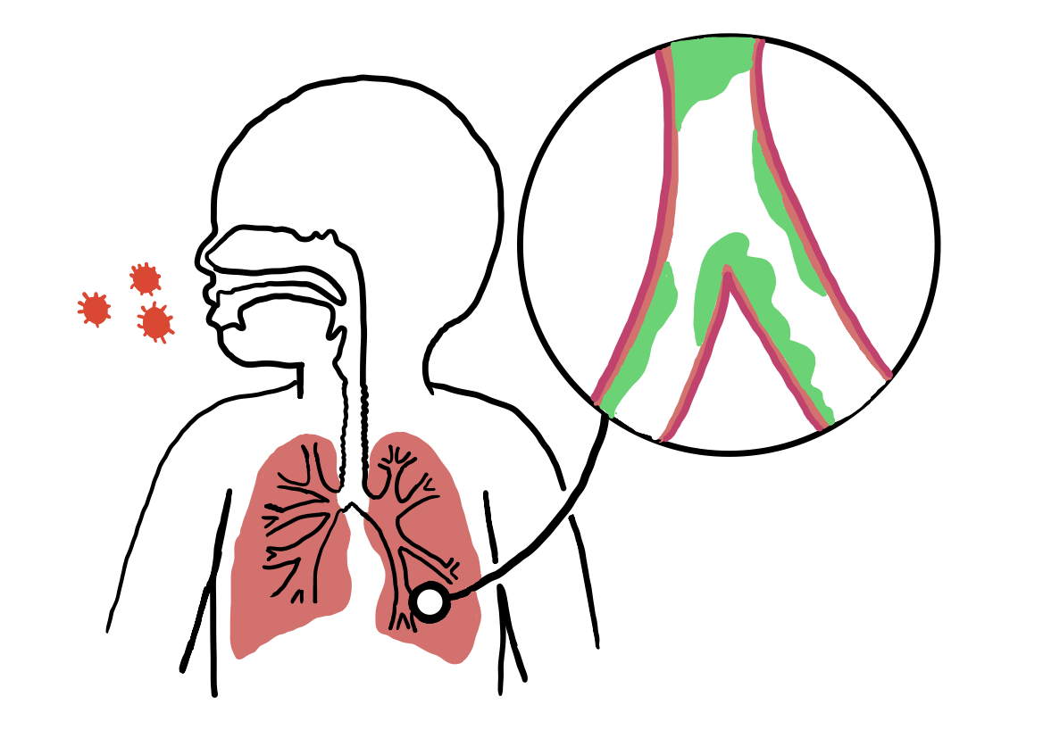 A line drawing of a child’s head and chest with the lungs shaded red and an enlarged circle showing an airway
